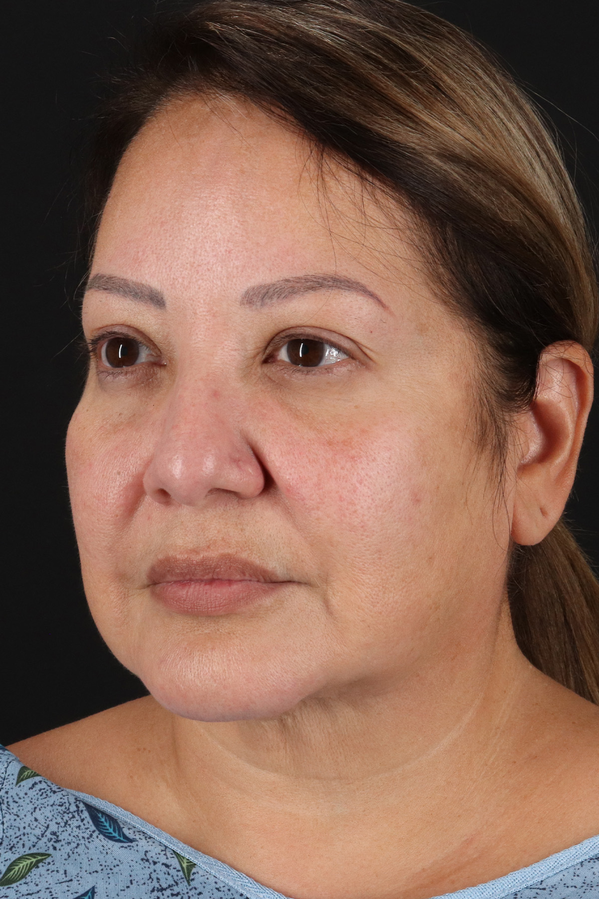Neck Lift Before & After Patient #2593