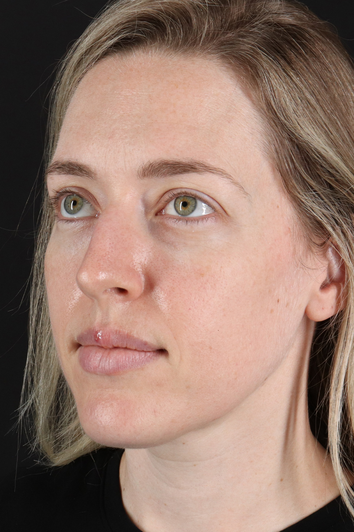 Rhinoplasty Before & After Patient #3291