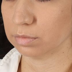Chin Implant Before & After Patient #1540