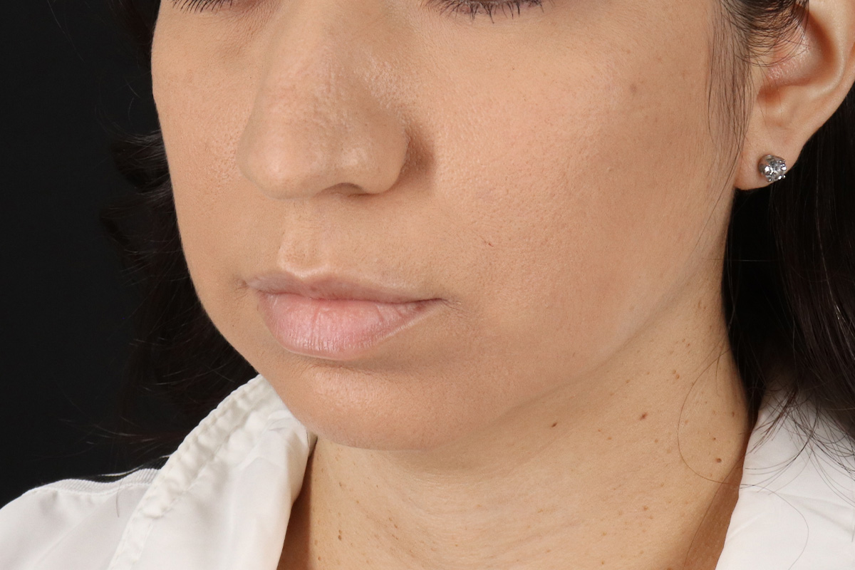 Chin Implant Before & After Patient #1540