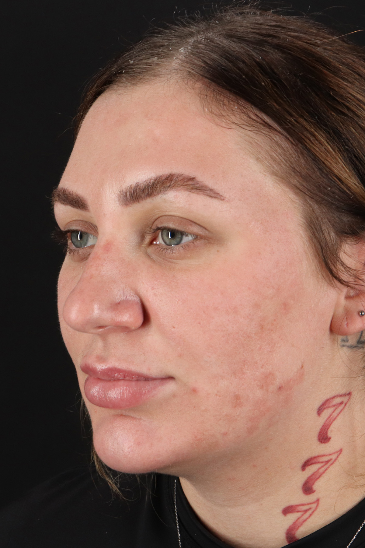 Rhinoplasty Before & After Patient #3104