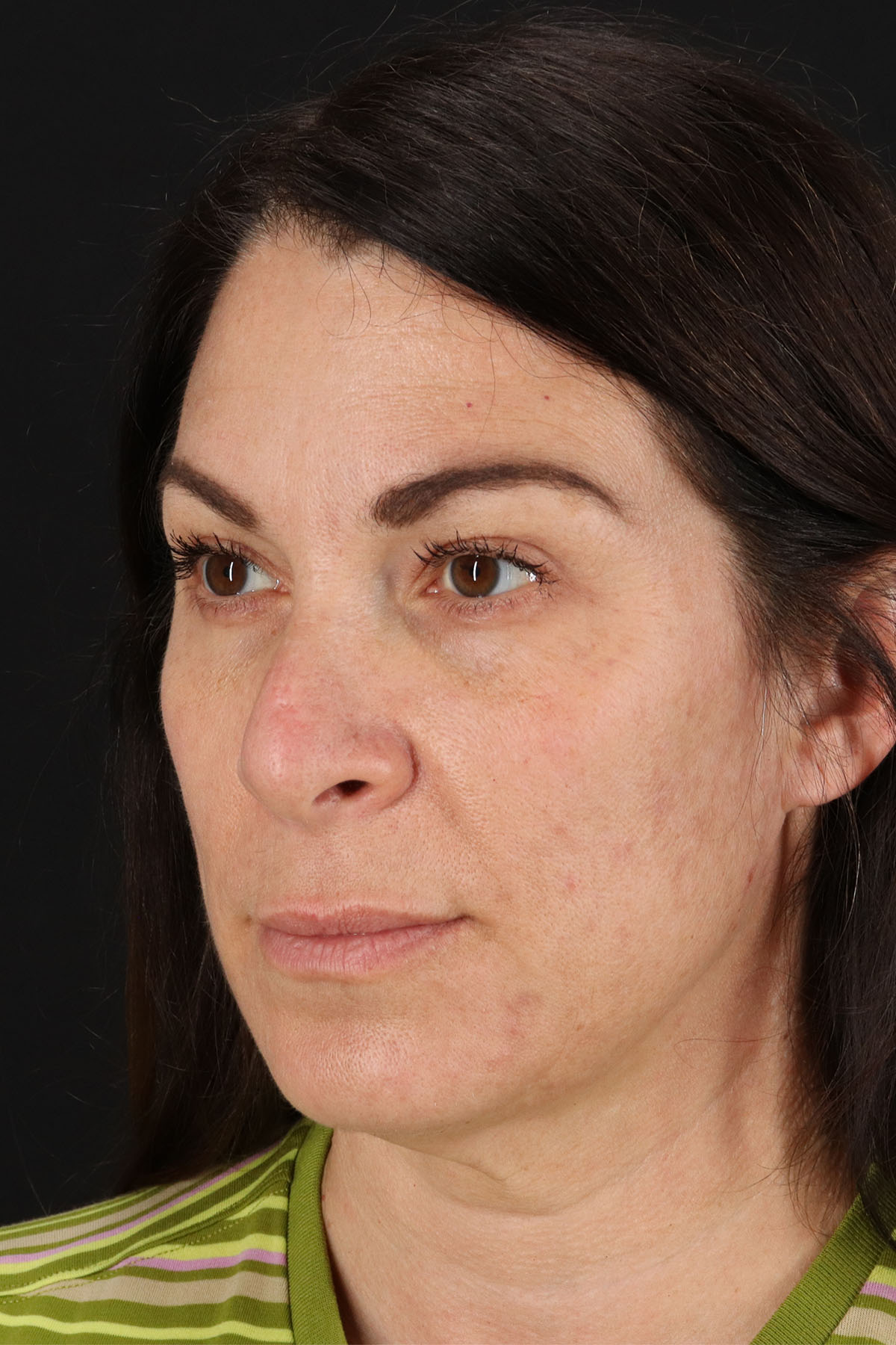 Lip Lift Before & After Patient #2133