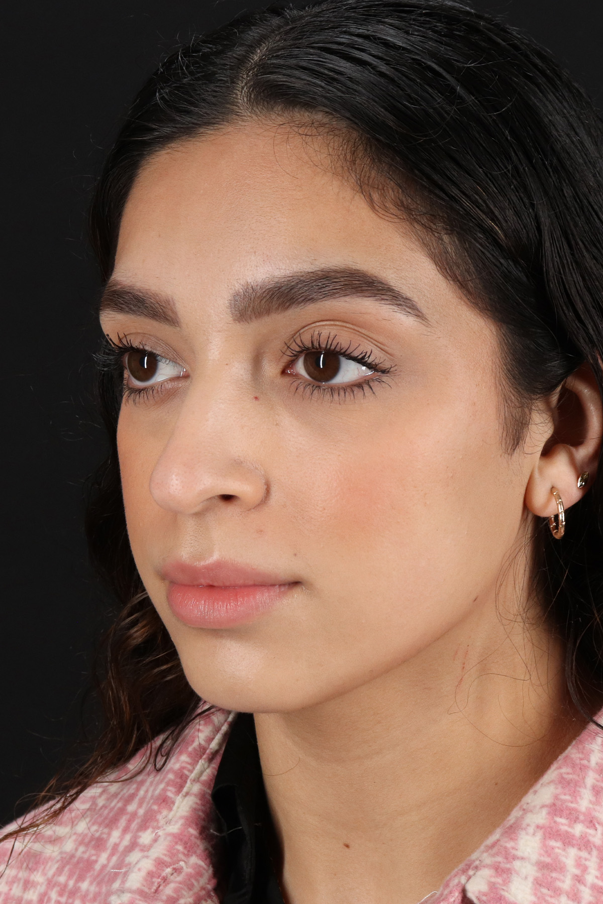 Rhinoplasty Before & After Patient #3269