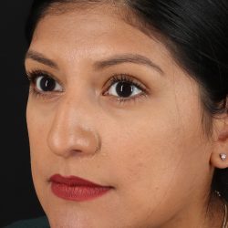 Rhinoplasty Before & After Patient #3181