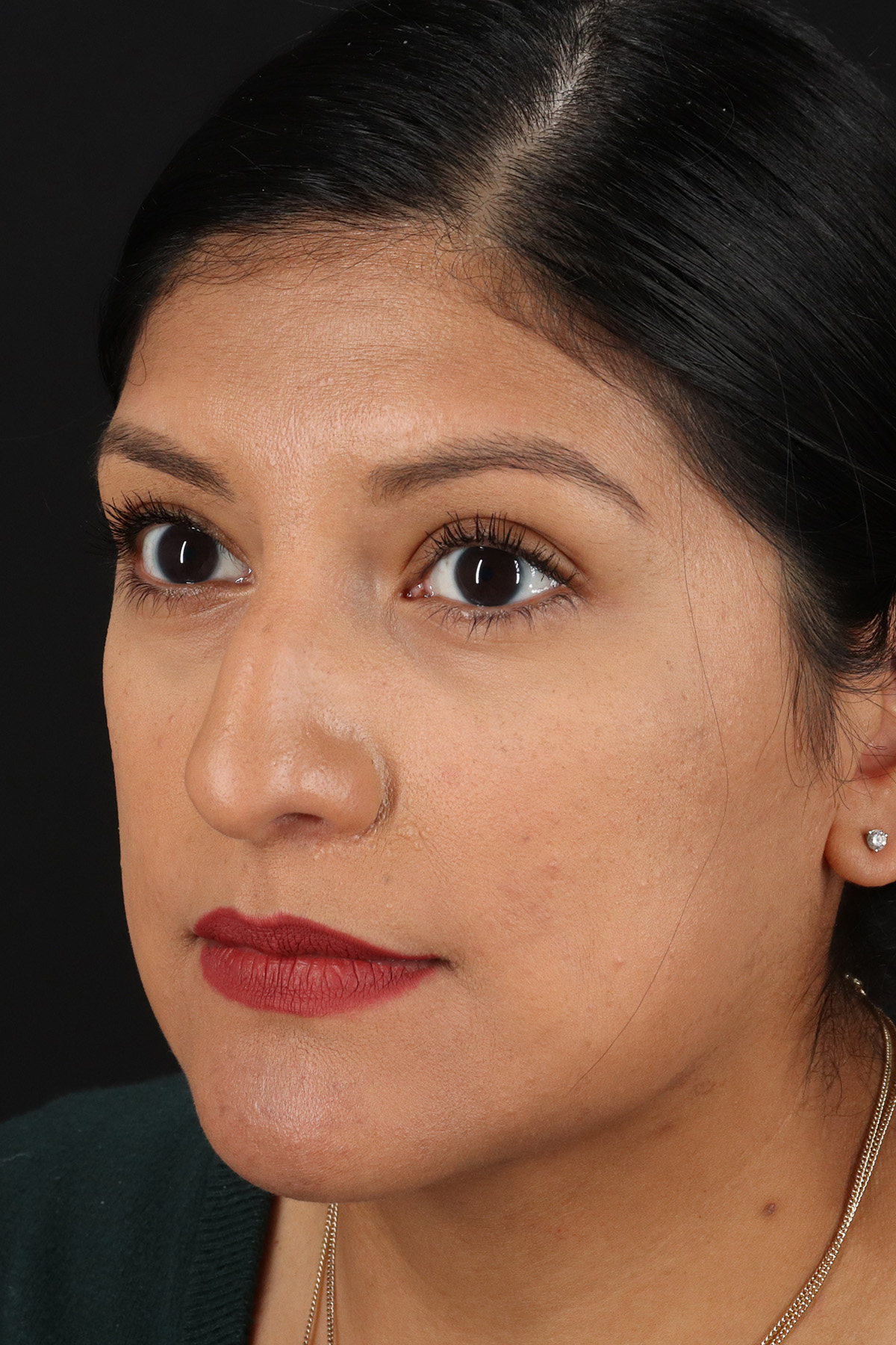 Rhinoplasty Before & After Patient #3181