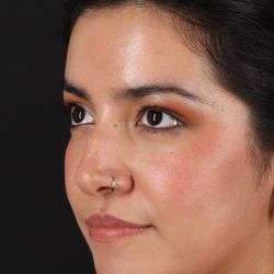 Fillers Before & After Patient #2041
