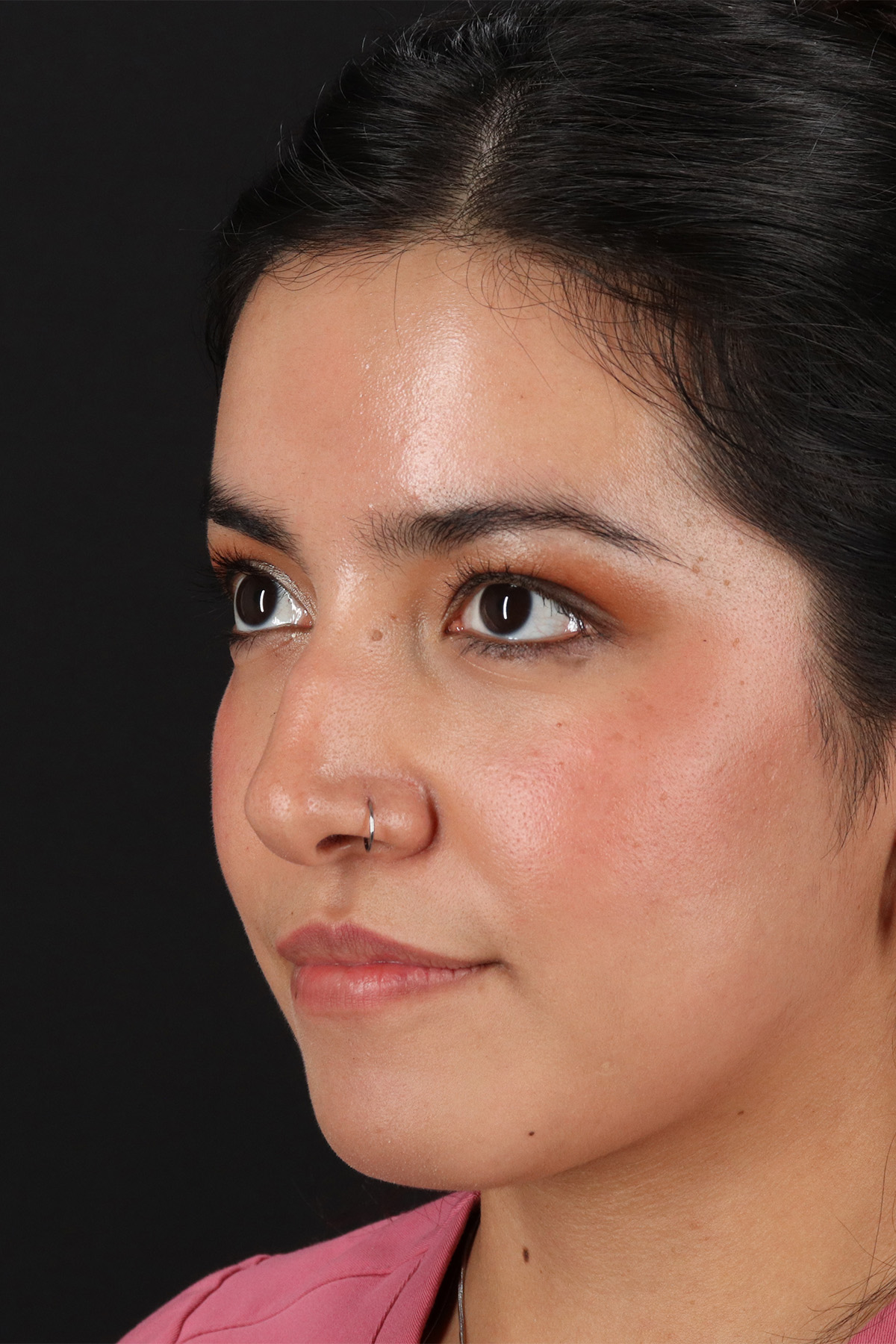 Liquid Rhinoplasty Before & After Patient #2265