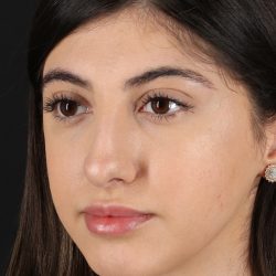 Rhinoplasty Before & After Patient #3214