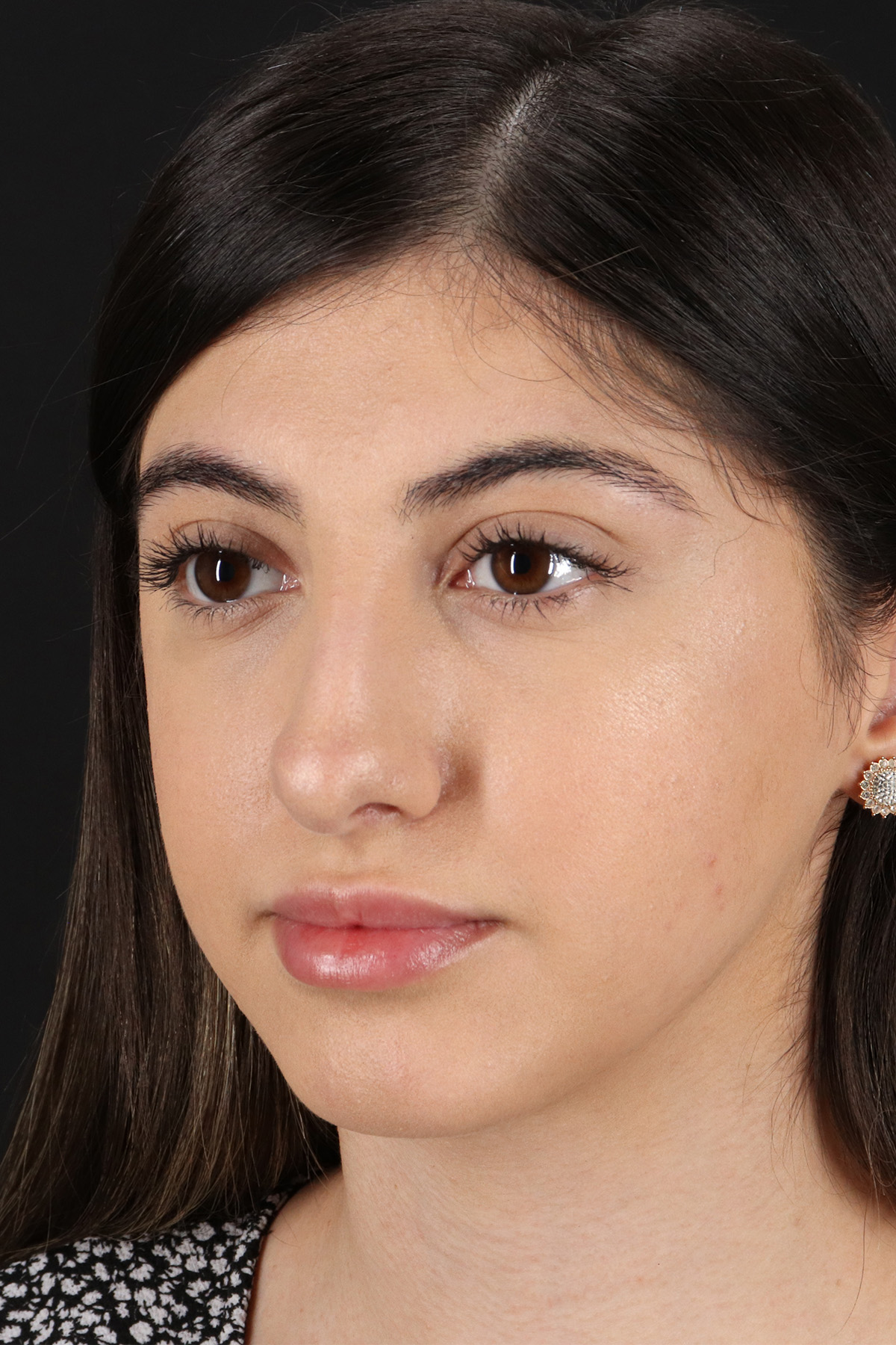 Rhinoplasty Before & After Patient #3214