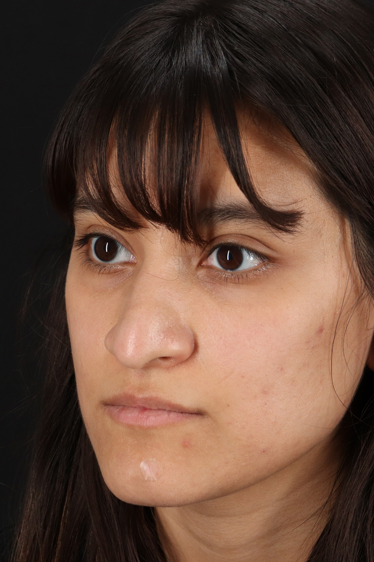 Rhinoplasty Before & After Patient #3038