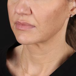 Neck Lift Before & After Patient #2626