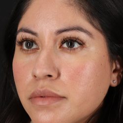 Fillers Before & After Patient #2063