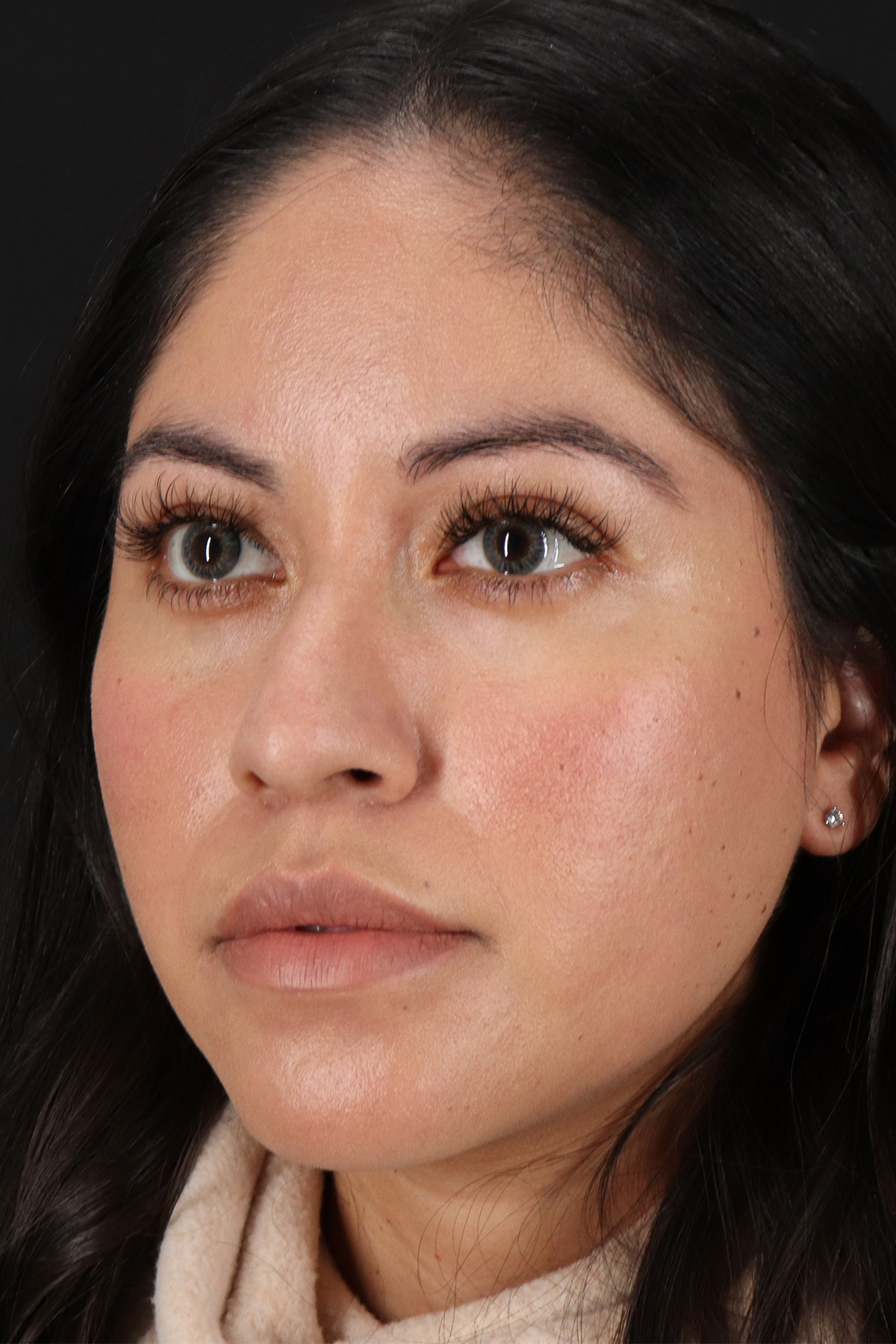 Fillers Before & After Patient #2063