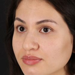 Rhinoplasty Before & After Patient #3236