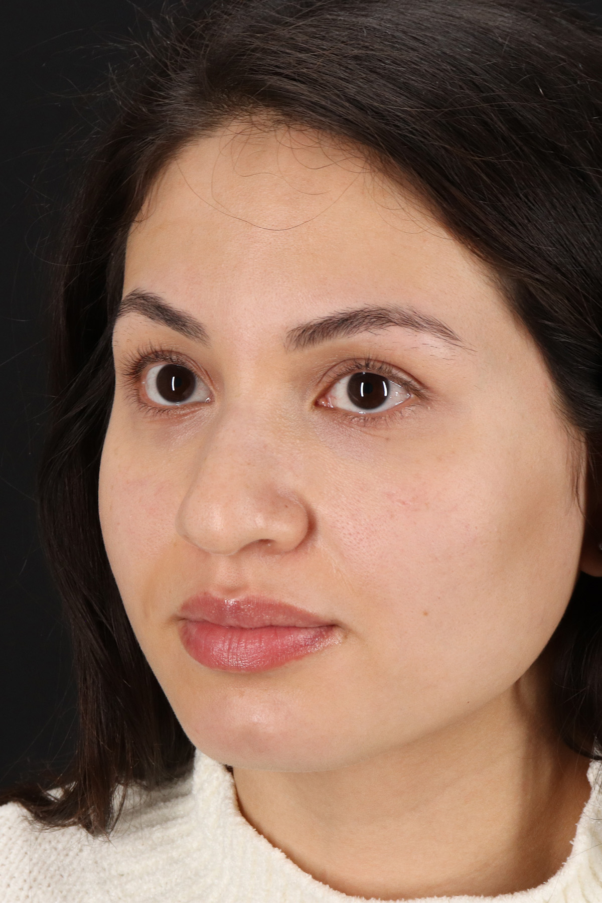 Rhinoplasty Before & After Patient #3236