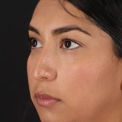 Liquid Rhinoplasty Before & After Patient #2232