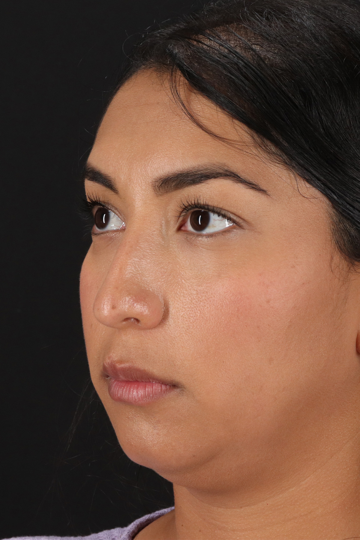 Liquid Rhinoplasty Before & After Patient #2232