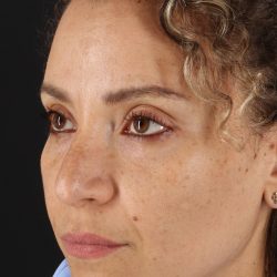 Liquid Rhinoplasty Before & After Patient #2276