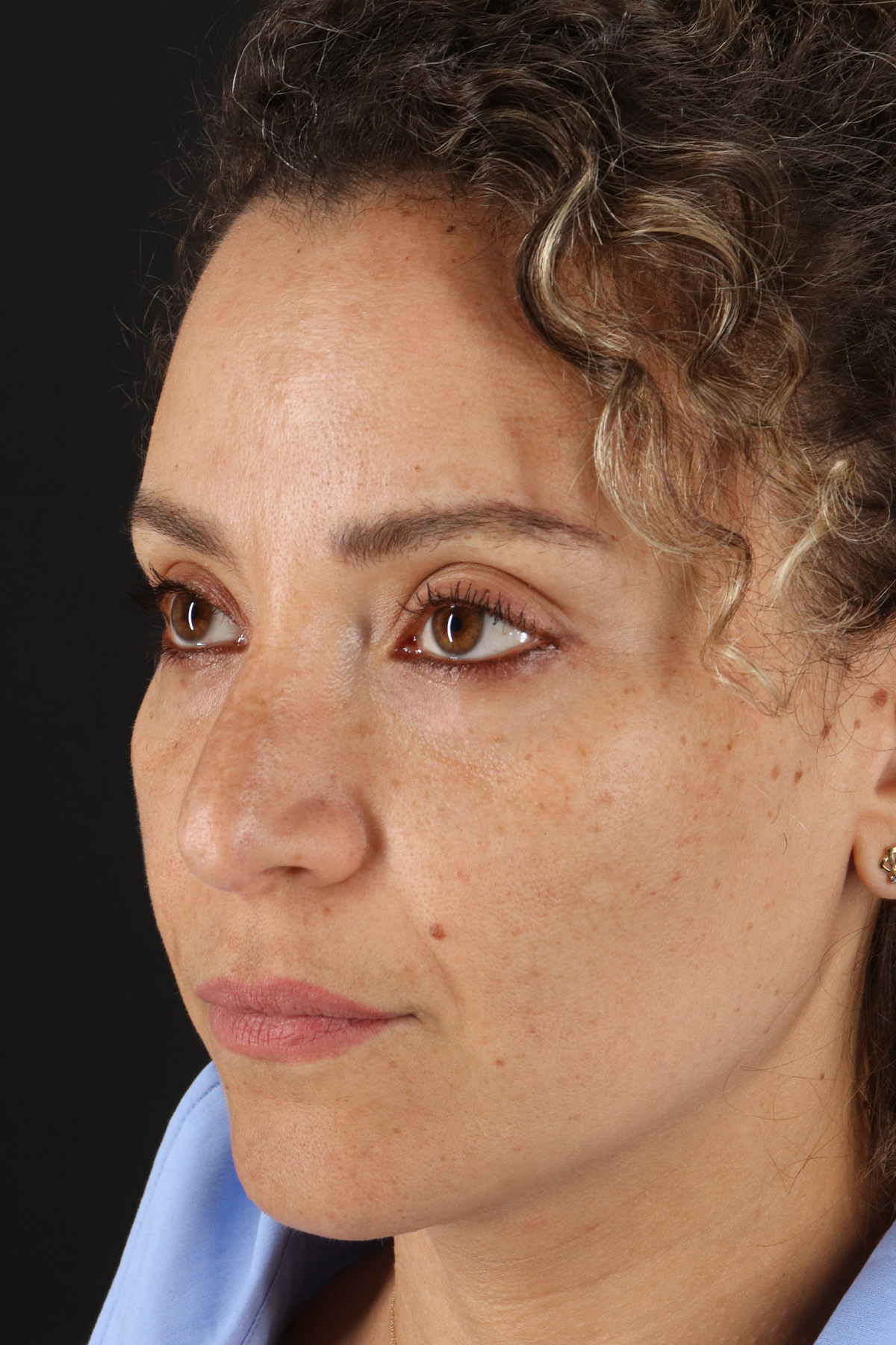 Liquid Rhinoplasty Before & After Patient #2276