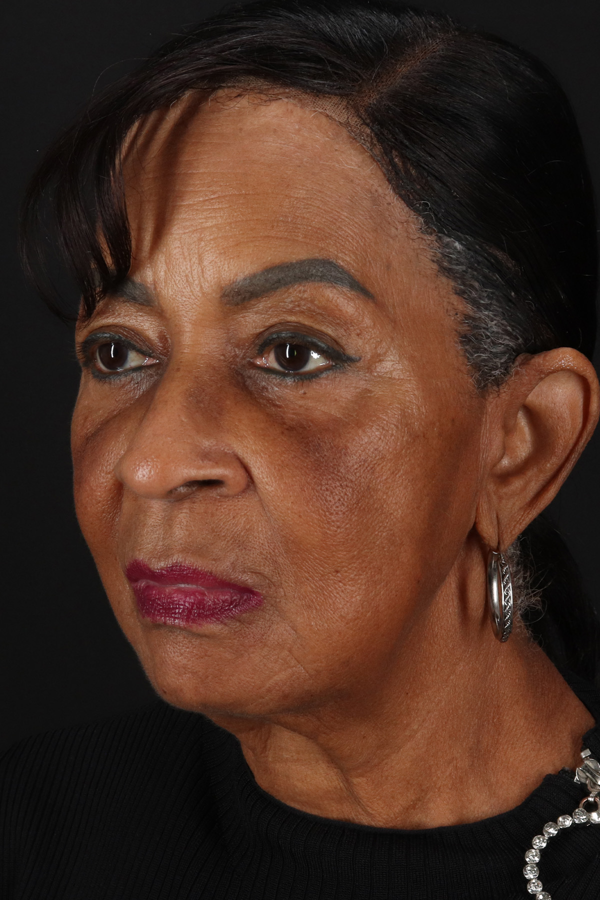 Facelift Before & After Patient #1910