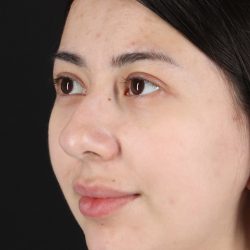 Rhinoplasty Before & After Patient #3159