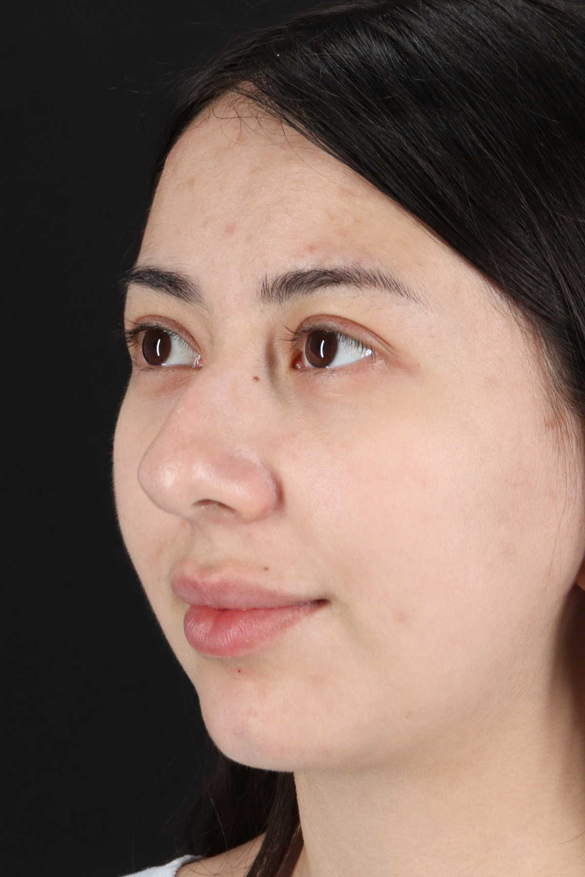 Rhinoplasty Before & After Patient #3159