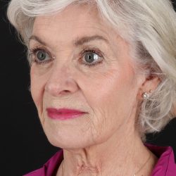 Upper Blepharoplasty Before & After Patient #5377