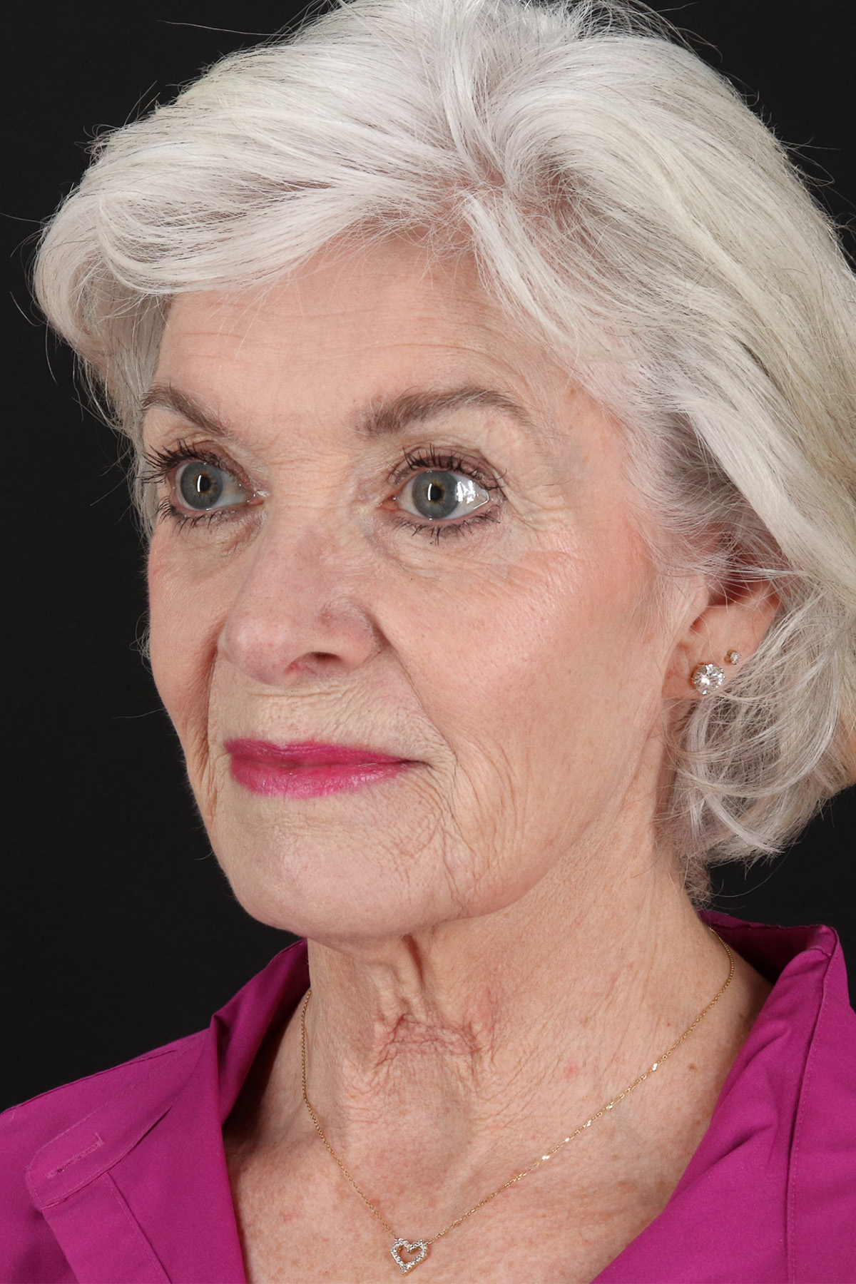 Upper Blepharoplasty Before & After Patient #5377