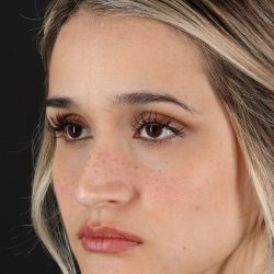 Rhinoplasty Before & After Patient #3258