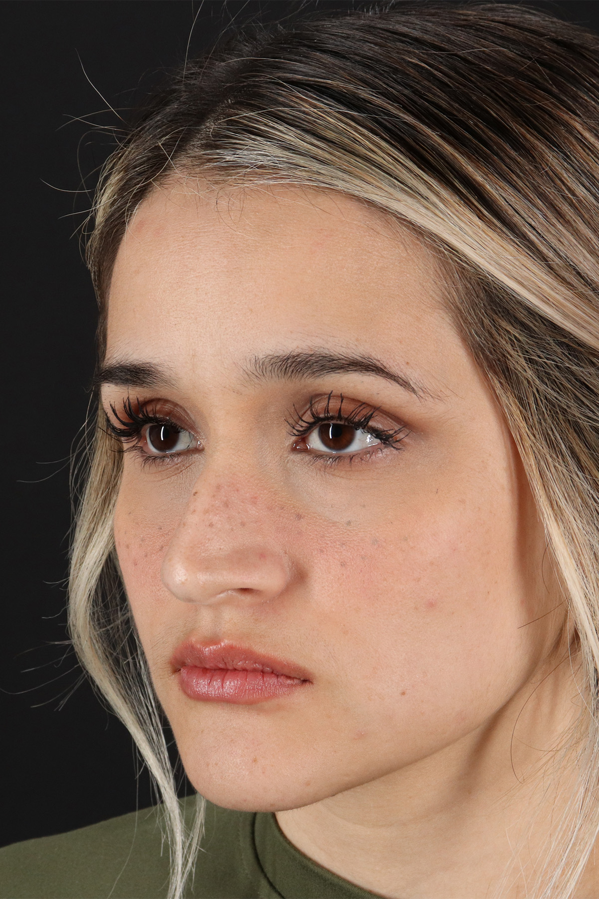 Rhinoplasty Before & After Patient #3258