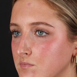 Liquid Rhinoplasty Before & After Patient #2221