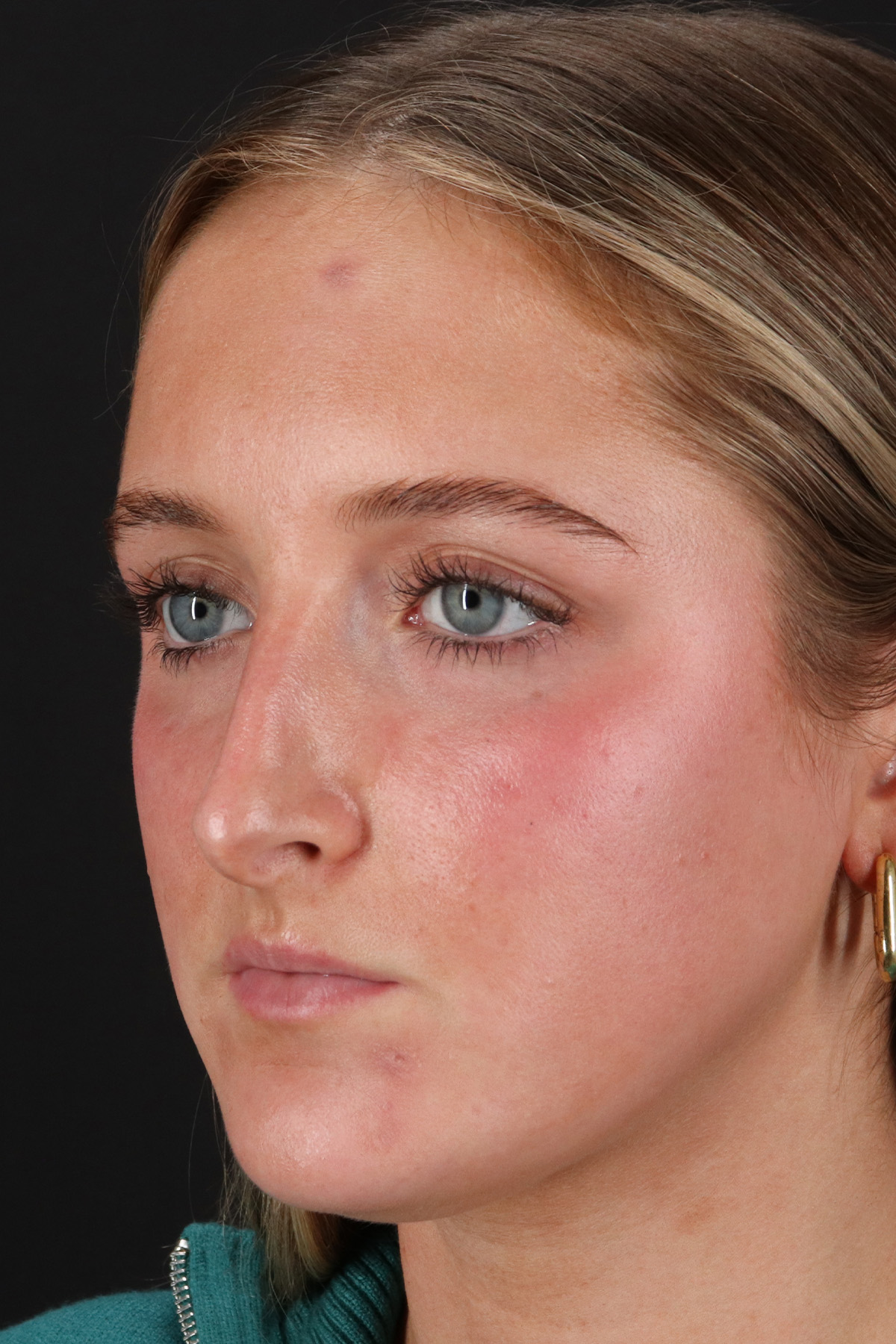 Liquid Rhinoplasty Before & After Patient #2221