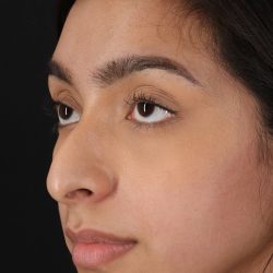 Chin Implant Before & After Patient #1637