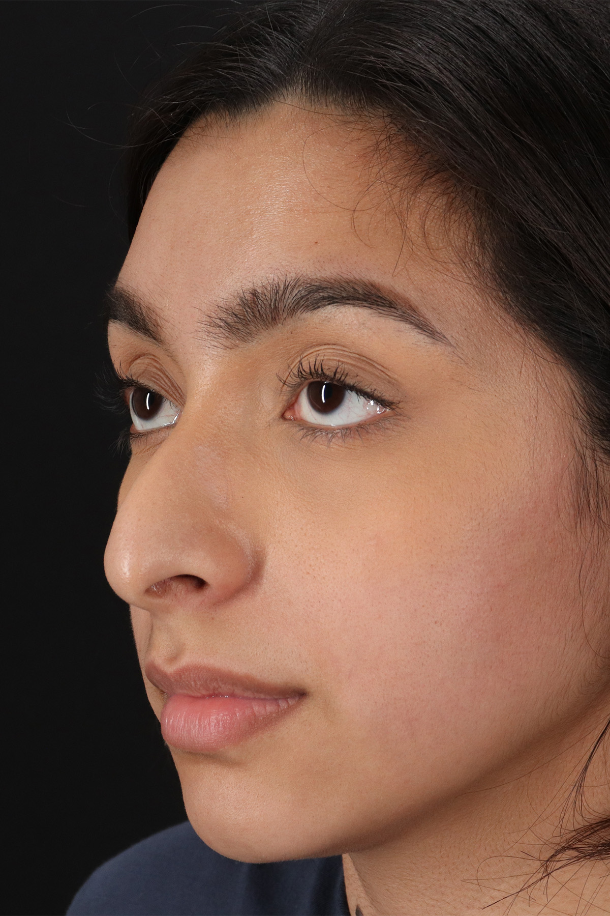 Chin Implant Before & After Patient #1637