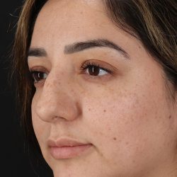 Rhinoplasty Before & After Patient #3115