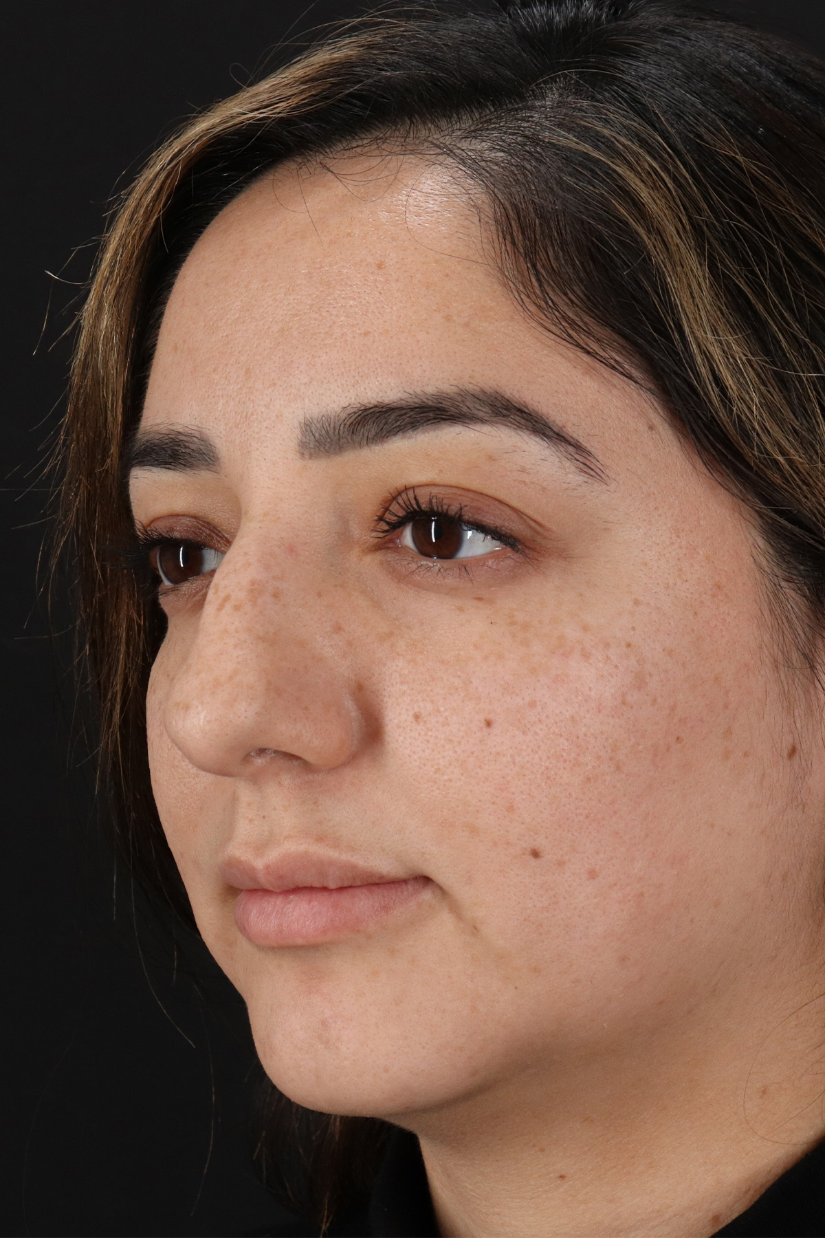 Rhinoplasty Before & After Patient #3115