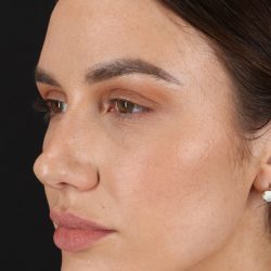 Rhinoplasty Before & After Patient #3137