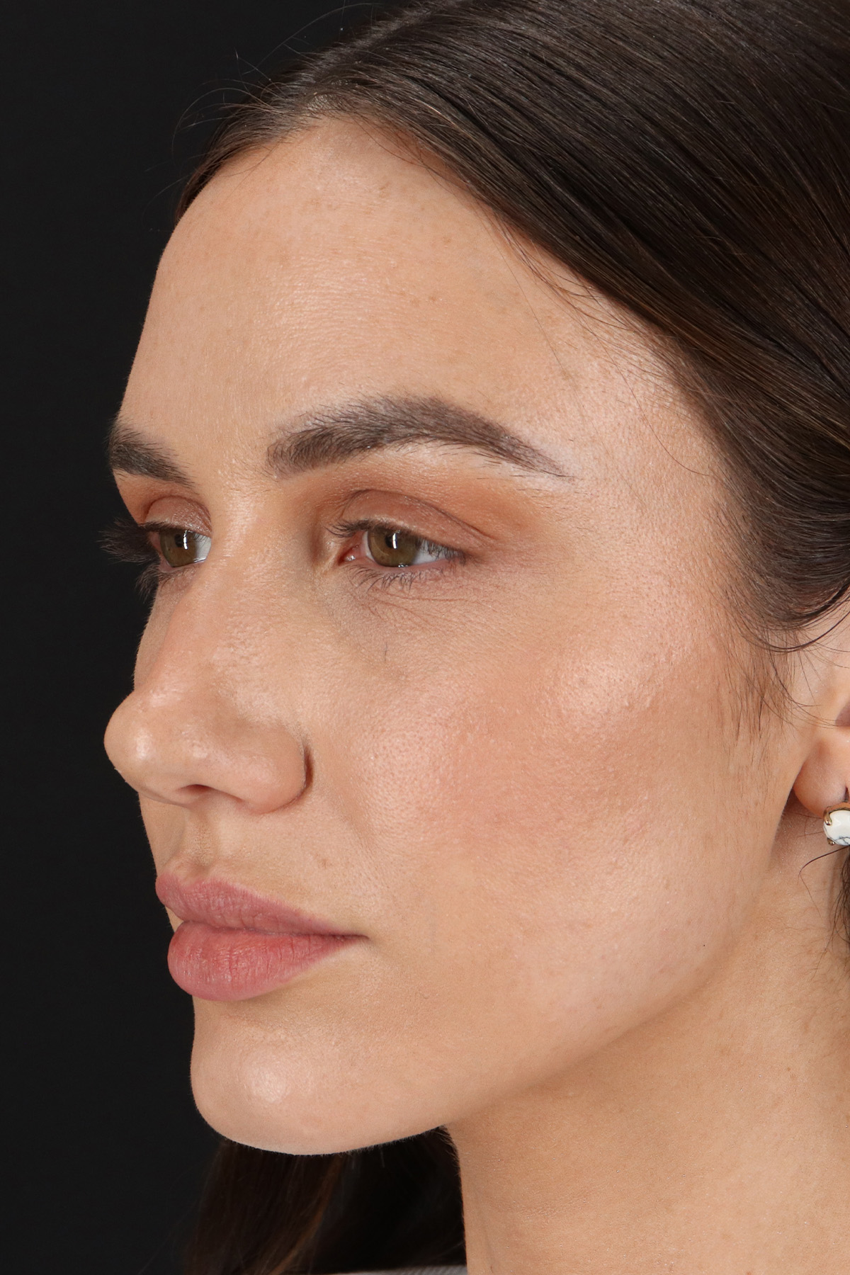 Rhinoplasty Before & After Patient #3137