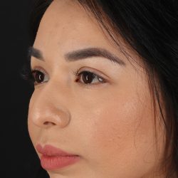 Chin Implant Before & After Patient #1626