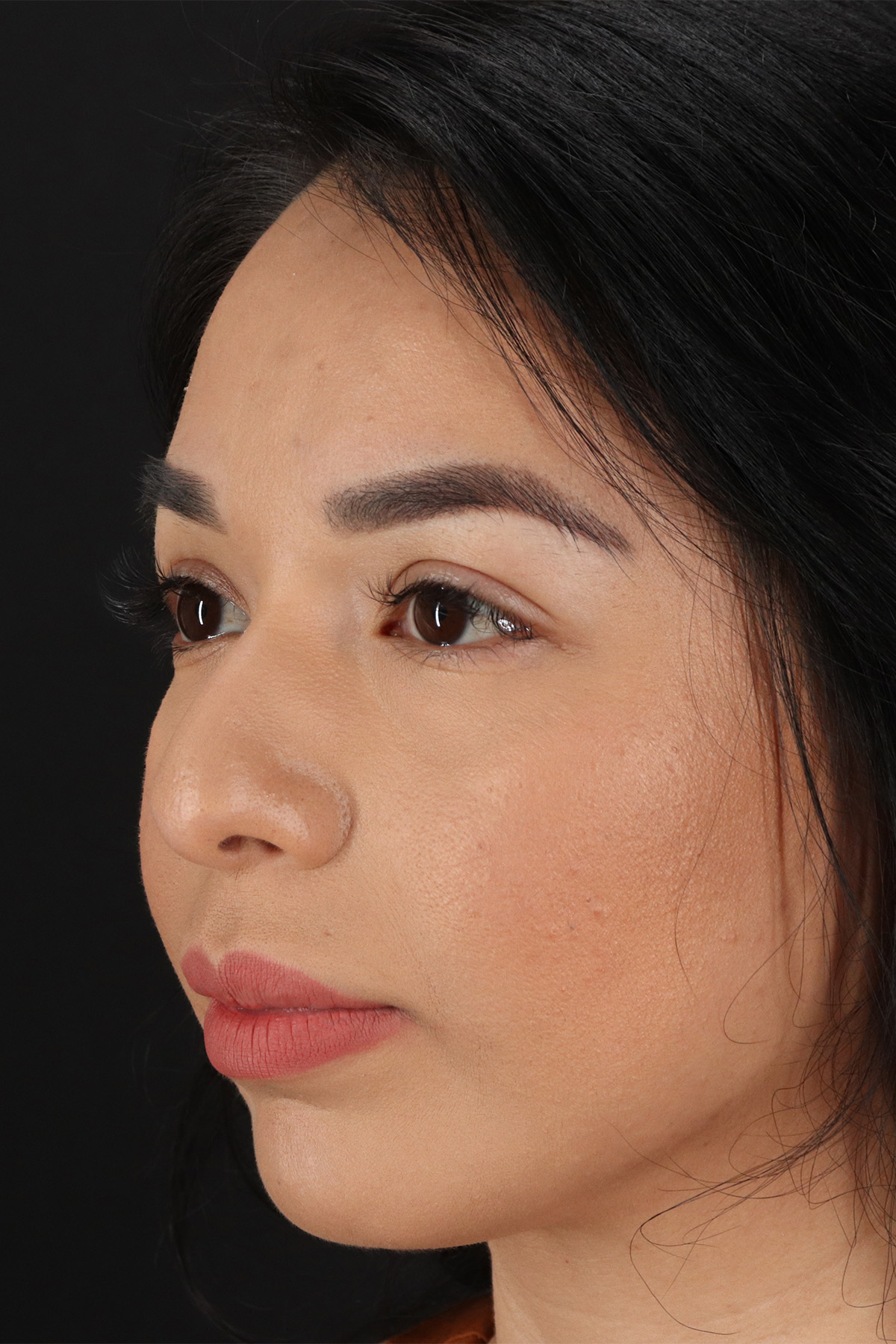 Chin Implant Before & After Patient #1626