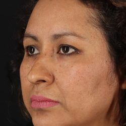 Rhinoplasty Before & After Patient #3225