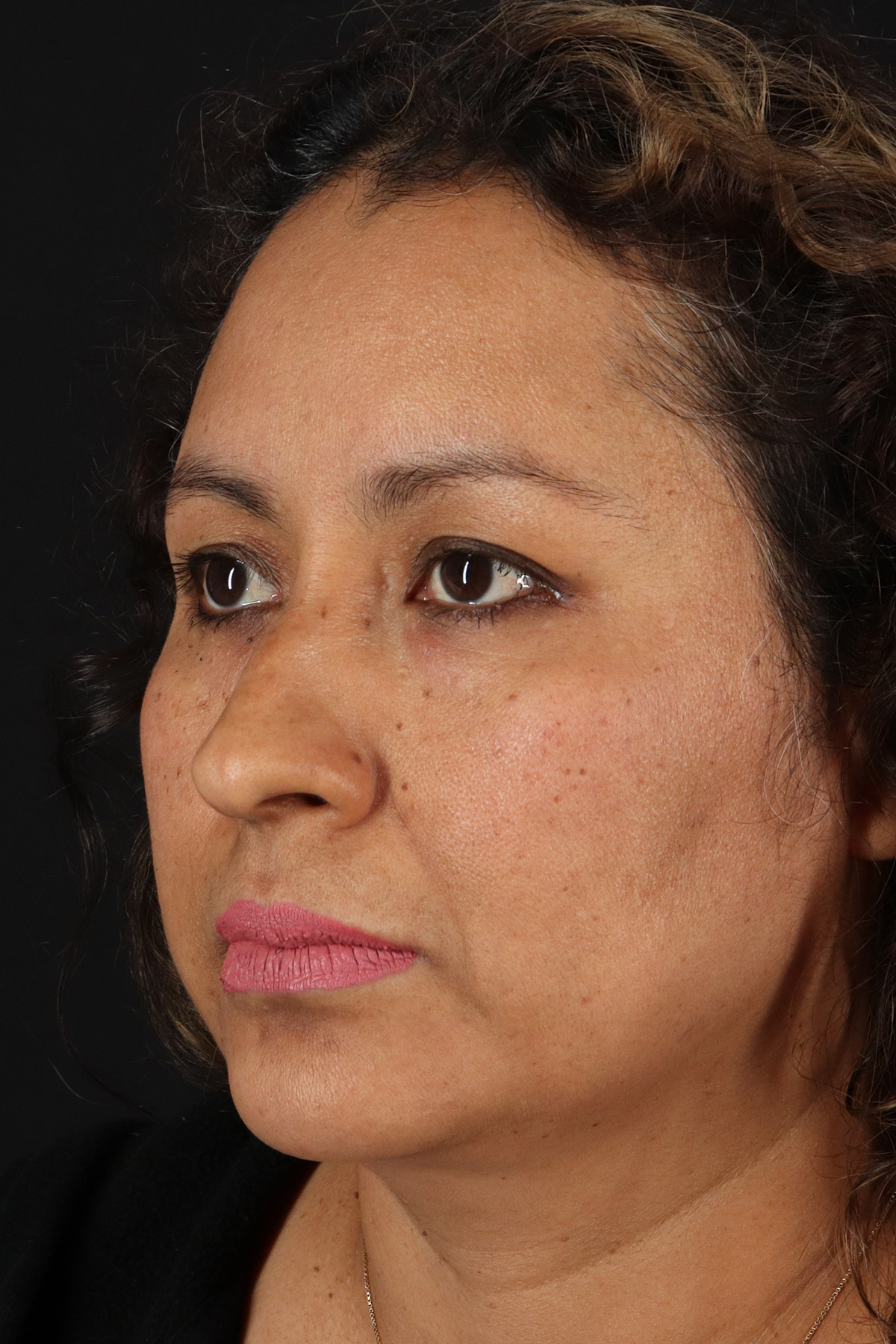 Rhinoplasty Before & After Patient #3225