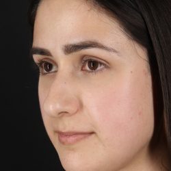 Liquid Rhinoplasty Before & After Patient #2188