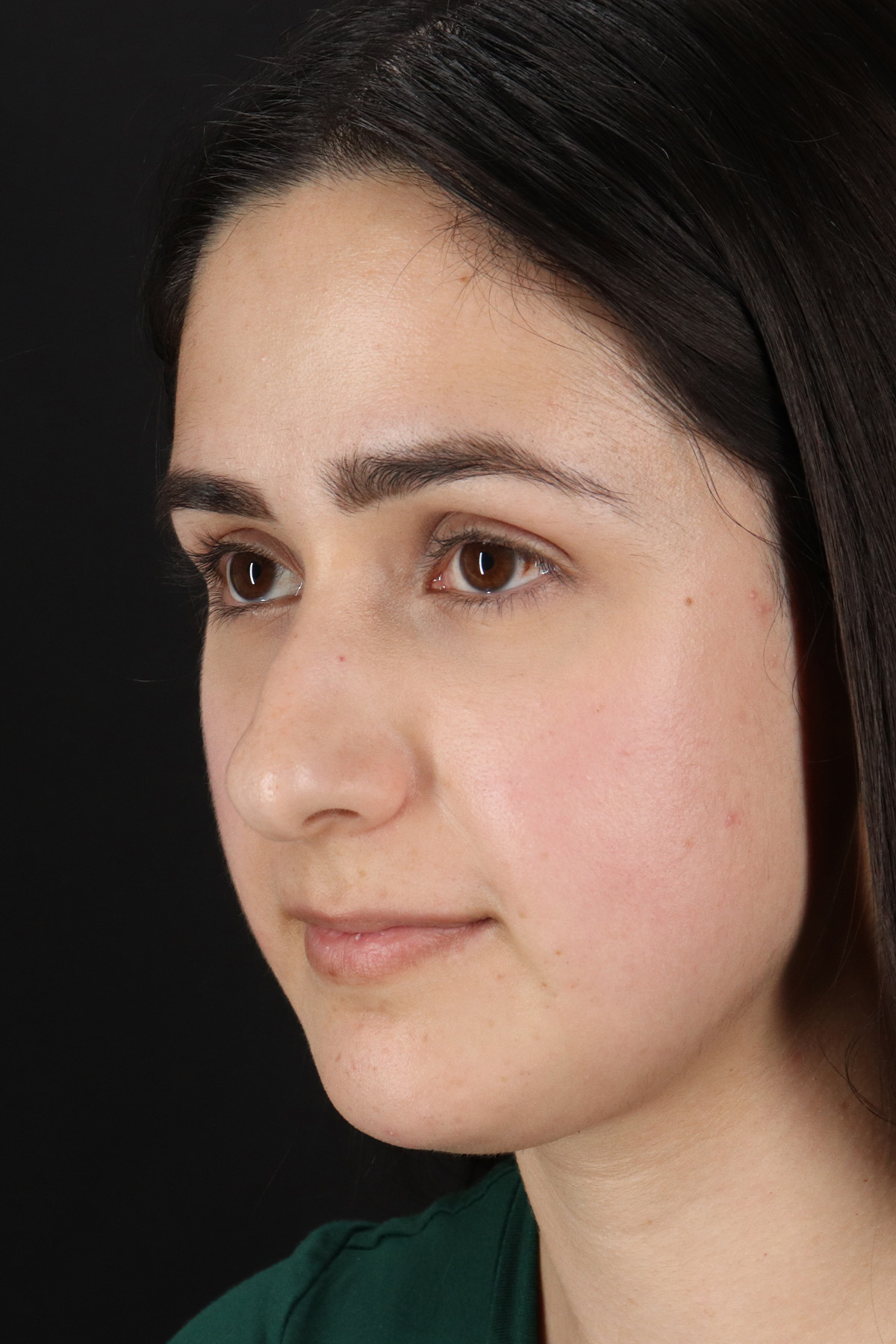 Liquid Rhinoplasty Before & After Patient #2188