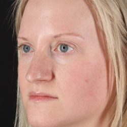 Rhinoplasty Before & After Patient #3126