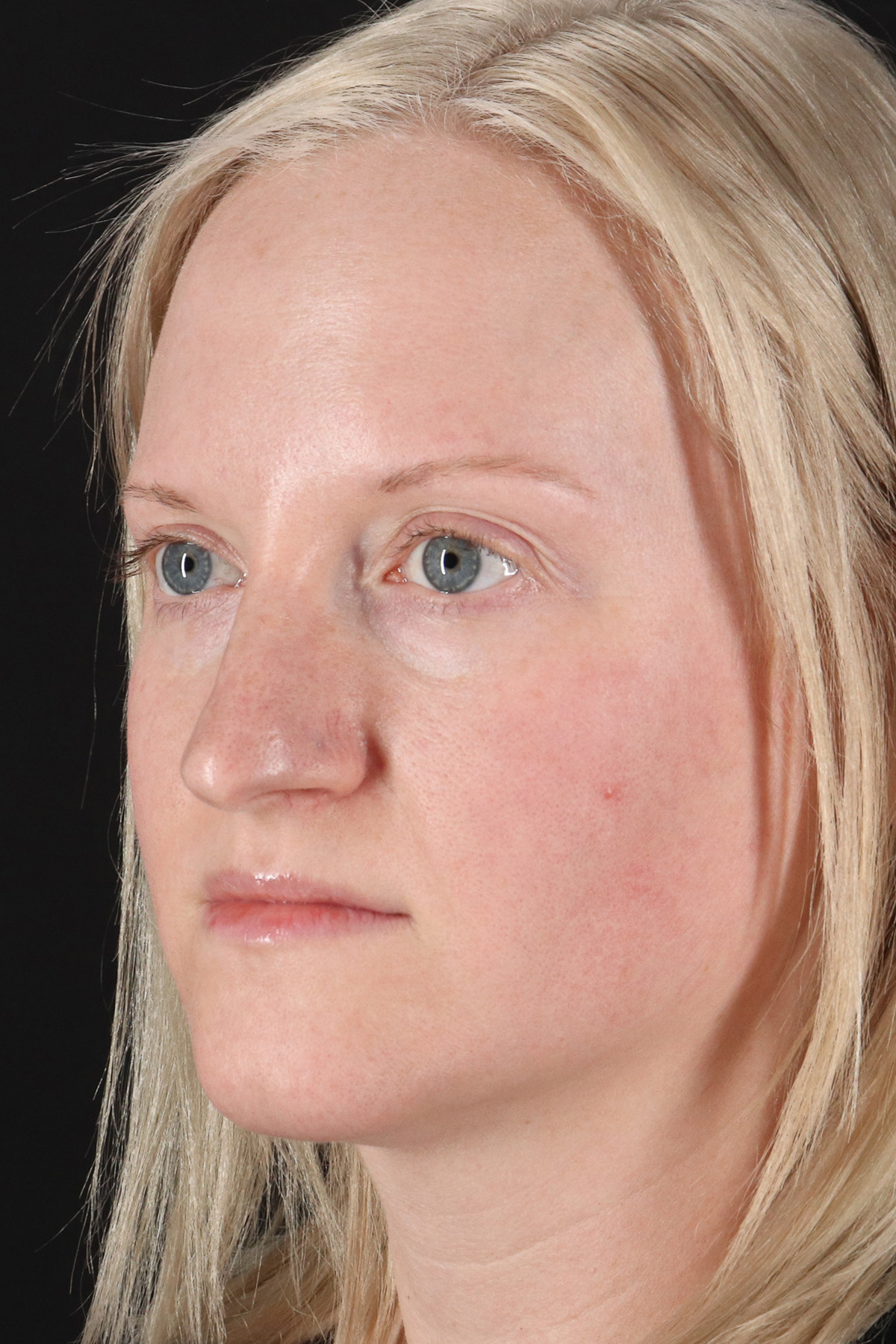Rhinoplasty Before & After Patient #3126