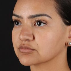 Rhinoplasty Before & After Patient #3192