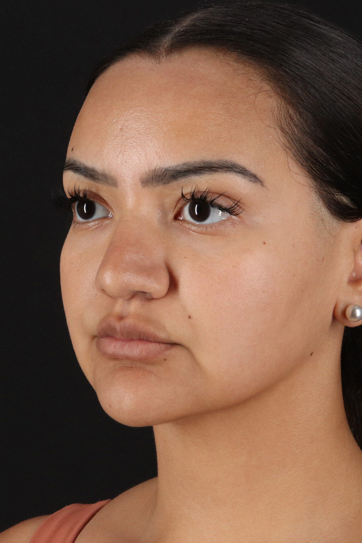 Rhinoplasty Before & After Patient #3192