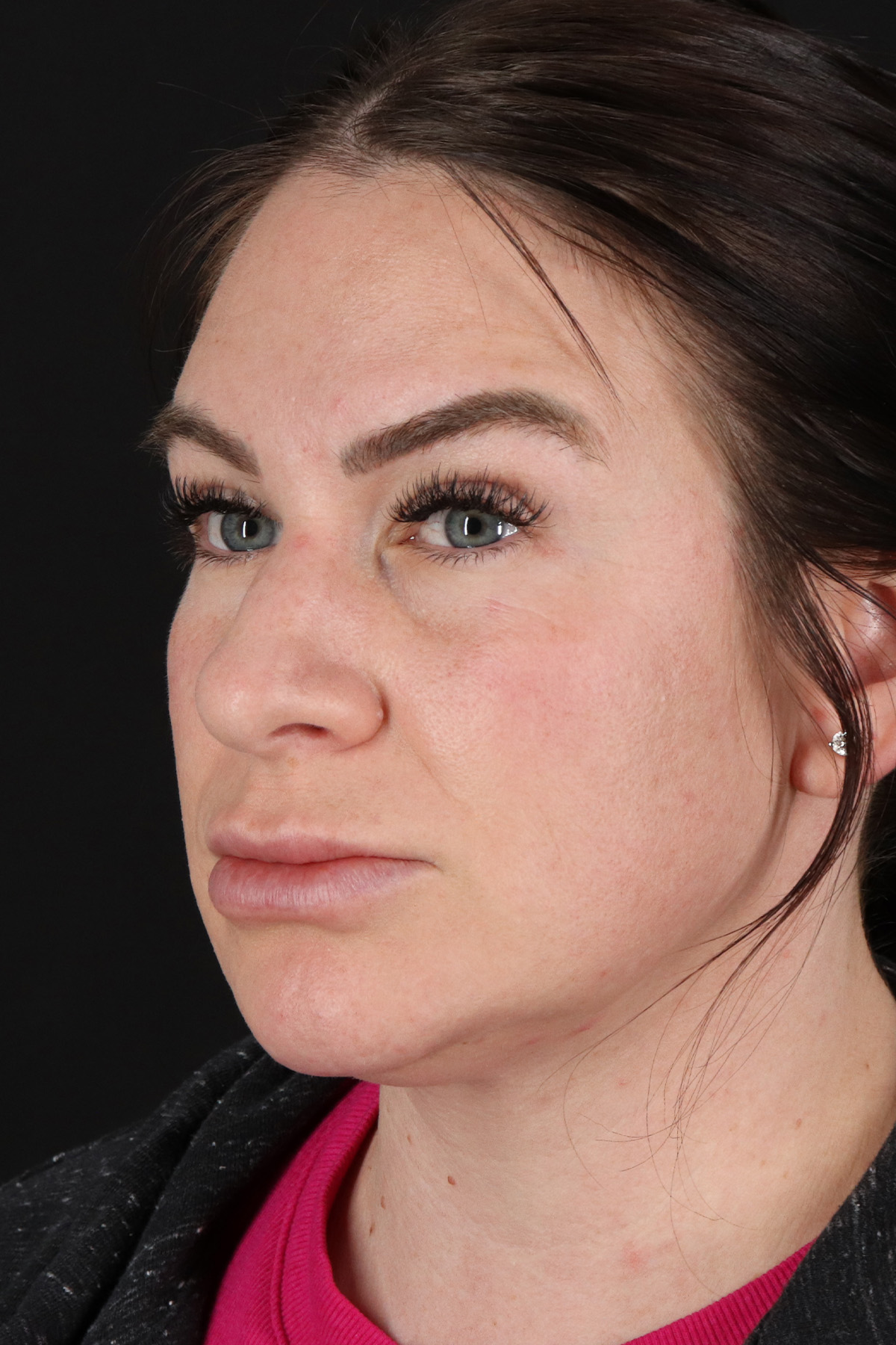 Rhinoplasty Before & After Patient #3093