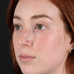Rhinoplasty Before & After Patient #3170